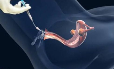 为什么试管婴儿胚胎移植后不长？